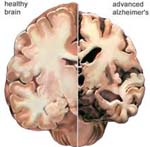 Alzheimer Disease